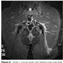 Muscle Edema: Classification, Mechanisms, and Interpretation 이미지