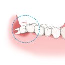 더꼼꼼한치과의원 | 마산 합성동 사랑니 발치, 더 이상 미루지 마세요! - 다미소치과 친절하고 꼼꼼한 발치 후기