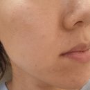 첫번째의원 | 창원 피부과, 예쁨주의 쁨의원 쥬베룩볼륨 1차 후기