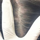 15.어의정맞은편 B | 대구 눈썹문신제거 아멜리아뷰티 2차 후기 및 관리법