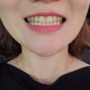 문정동치과에서 치아미백 받고 온 전후 비교 후기