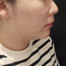 용피부과의원 | 청담 피부과 30대 직장인 이중턱 리니어지 솔직후기(효과,통증)