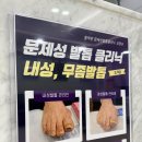 엄재활의학과의원 | 서울활짝편재활의학과 양천구 무좀치료 시술 효과 솔직 후기