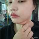 (주) 바이블 | 파주 야당역 피부과 DCA 지방파괴주사 바이블주 이중턱살주사 후기 윤곽주사 2주차에 만난 매끈한 턱라인