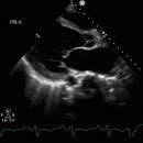 Peripartum cardiomyopathy (PPCM) 이미지