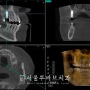 부기먼트