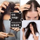두피 가려움 해결의 비밀, 하얀눈꽃가루 샴푸 직접 써본 리얼 효과는?