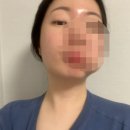 고고한의원 | 한의원 피침요법 얼굴 &amp; 팔 점빼기 후기 (+트리플 바디 체험)