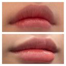 에이스마일치과병원 | 본식 3주 앞두고 맞은 입술필러, 입꼬리 보톡스, 거미스마일 잇몸보톡스 후기