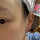 아젤리아 | 아젤리아크림 솔직후기 2편 (2주 차 | 부작용과 완벽한 제거)