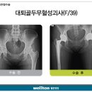 [고관절 인공관절.대퇴골두 무혈성괴사]대퇴골 무혈성 괴사 로 인한 고관절 인공관절수술을 받게 되는 원인들. 이미지