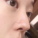 콧볼 보톡스 후기 맑은윤의원 구의점