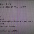 로봇과친구되기1 | 아인병원 갑상선암 후기, 성대 근처 단일공 로봇수술 후기 (이진욱 교수님)