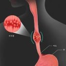 식도암 초기증상 원인 통증 치료 예방방법 이미지