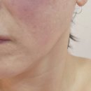 (주)케어핏 | [부평피부관리] 울쎄라보다 만족스러운 '스킨케어톡' 페이스핏톡스 V라인 리프팅 후기