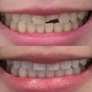 아름드리치과의원 | 신논현치과 앞니 골절 라미네이트 치료 과정, 최종 부착 후기(전후사진)