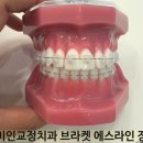 에이라인치과병원 | 교정치과 서울 치아교정치과 동대문구 이미인교정치과...메탈,클리피씨,에이라인,에스라인)는?여름 방학...