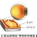 중심성 망막염 및 (중심장액성 맥락망막병증, 시야흐림) 이미지