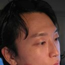 논현1-102 | 강남 논현 피부과 눈밑지 수술 대신 루엘프팅 하고 확실히 달라진 후기