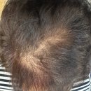 제이드7 | "얇아지는 모발, 정수리 탈모, 서울 SMP 두피문신 7차후기 [제이드_건대점]"