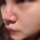 르네의원 | 오가나셀 피부과 울트라 클리어 흉터제거 5회 후기