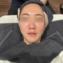 사르티네의원, 통증없는 리프팅 쿨소닉 7000샷 후기 (펜타입 울쎄라)