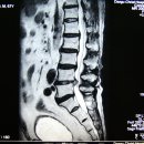 허리디스크 치료사례-2 요추 4-5번간 추간판 탈출증(2번의 수술후 재활치료사례) 김*님 남자/70세 이미지