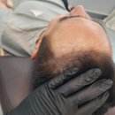 헤드샷스칼프SMP부산 | 하와이스칼프 헤어라인 두피문신 M자 탈모 커버 솔직 2회차 진행 후기