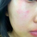 엠디메디칼 | 부천피부과전문의 찾아간 후기 :가려움, 부음 피부질환 치료과정