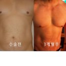 40대 아저씨의 몸짱 프로젝트 / 복부 지방 흡입후 2년이 지난 지금. 이미지