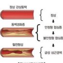 심근경색 전조증상 원인 치료 심근경색 골든타임 심근경색 좋은 음식 이미지