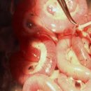 소장 이식[small bowel transplantation] 이미지