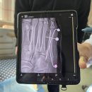 11545-02-08-68 | 발등뼈 골절 기록 ] 1년 동안 병원 2곳 수술 2번 재수술 후기