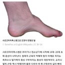 삼성 일가가 앓고 있는 희귀 유전병 이미지