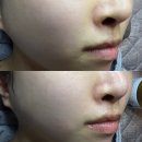서면 아쿠아필ㅣ플라즈마 전문 에스테틱 ‘메이니뷰티’ 아쿠아필 후기