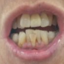 부강치과의원 | 사랑니 발치 후기