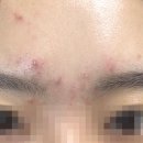 석촌역피부과 전문의가 있는 연세에이엔비피부과 여드름치료 1회차