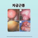 이민정산부인과의원 | 자궁근종하이푸 vs 자궁근종수술, 어떤 치료가 더 좋을까요?