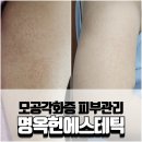 명옥헌한의원 | 오돌토돌 닭살피부 모공각화증 없애기 위해 다녀온 명옥헌에스테틱 (팔여드름 등여드름)