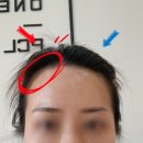 동원 | 천안두피컨설팅 천안헤어라인컨설팅 불당동원썸뷰티 다녀온 솔직후기