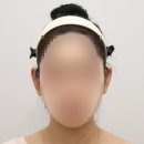 소이의원 귀필러 전후 / 미인귀 후기
