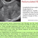 Pedunculated fibroid 이미지