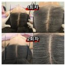 리온스포츠 | 광주 두피 탈모관리 리온테라피 두피 종합 케어 전후 비교 후기