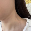 성심한의원 | 한림대 동탄 성심병원 안면마비 후유증으로 인한 입원 집중치료 후기