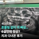 어른과아이들치과 | "유치 빠지는 시기" 맞나요? 6살 아이 흔들림 없이 갑자기 이 빠져 치과 다녀온 후기