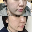 아란 | 한남동 피부과 줄기세포 스킨부스터 내돈내산 아란셀 일주일 후기