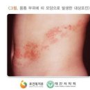 대상포진 예방접종 백신, 50대 필수 백신으로 부모님 건강챙기기 이미지