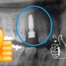 이재민치과의원 | 임플란트 식립후기