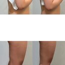 두산테라피 | 대구 수성구 더에스테틱수미원 호르몬 다이어트 테라피 후기!