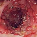 드림인터벤션 | 크론병 증상 원인 자가진단 치료 방법까지 알려드림